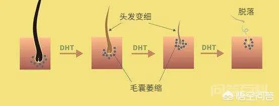 后枕部头发、毛囊为何坚固无比很难脱落?-图片3