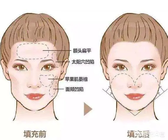 额头窄是一种什么样的体验?-图片6