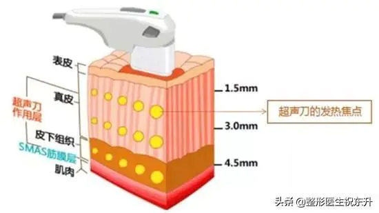 超声刀美容失败怎么办?-图片4