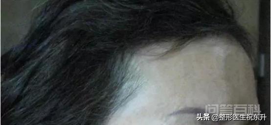 超声刀美容失败怎么办?-图片3