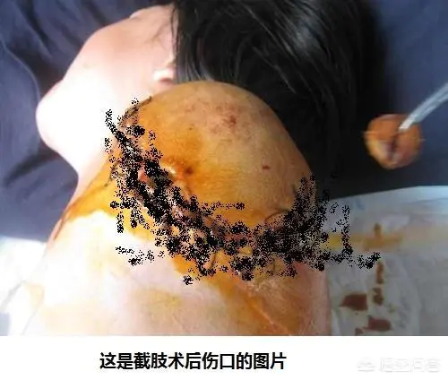 手截肢了,血管也断了,最后愈合血管能形成回流吗?-图片2