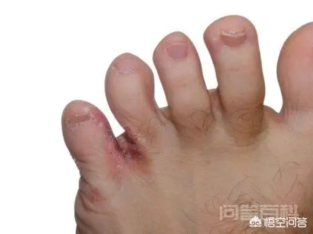 我家小孩六岁就有脚气该怎么办?有什么偏方可以治疗吗?