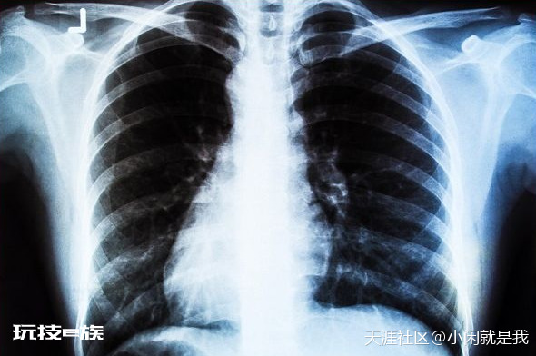 [多图]引起肺癌的原因 肺癌疾病有哪些症状？-图片3