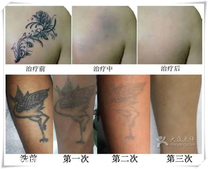 三种帮你彻底清除纹身的方法(图)-图片3