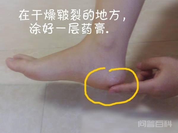 脚后跟开裂起硬皮,经常勾被单,怎么办?-图片4