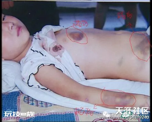 后妈毒打6岁继女,治疗现场千人哭成一片-图片1