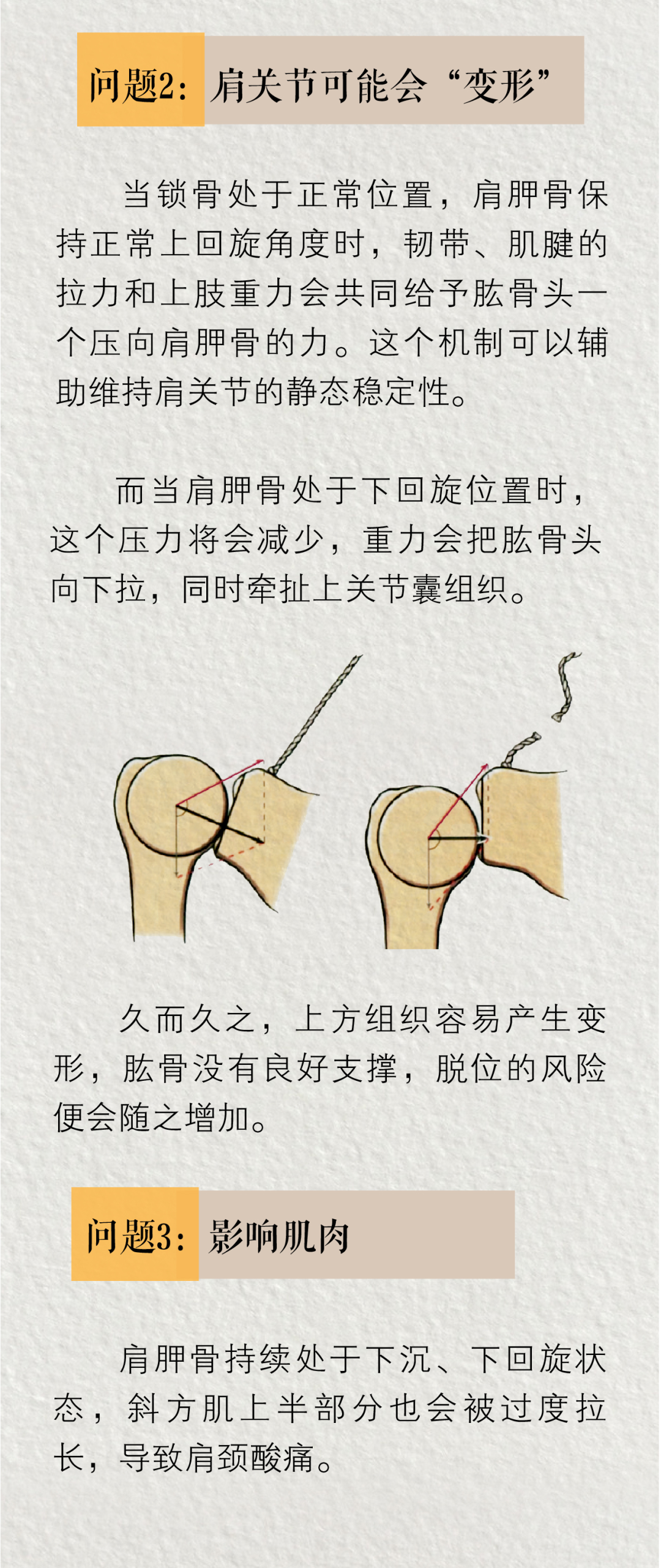 直角肩到底有多“反人类”？骨科医生说出了大实话……-图片1