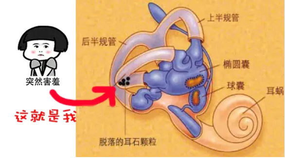 眩晕恶心,竟是耳朵里的“小石头”跑偏了?-图片3