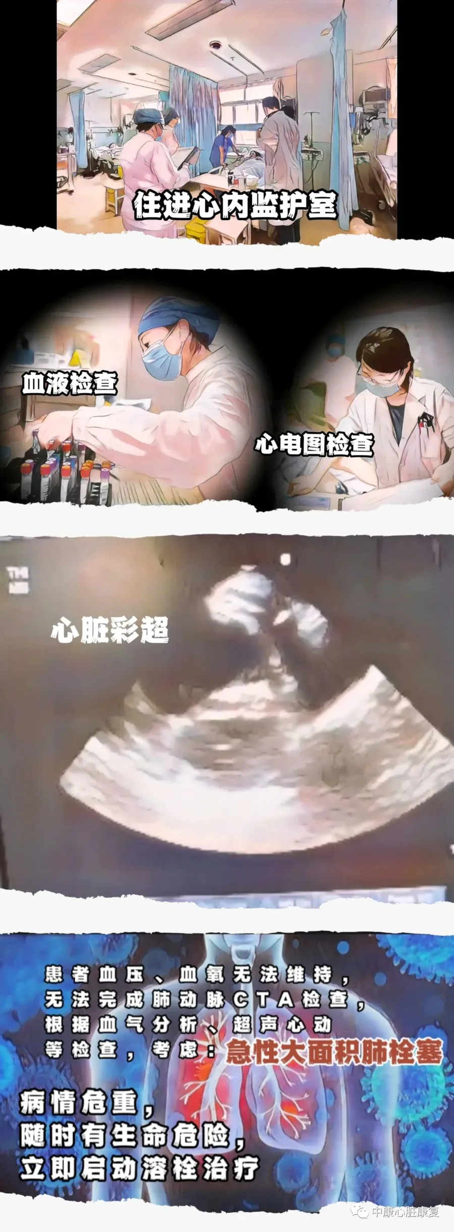 【专家科普】不可忽视的健康杀手—–肺栓塞(一)-图片2