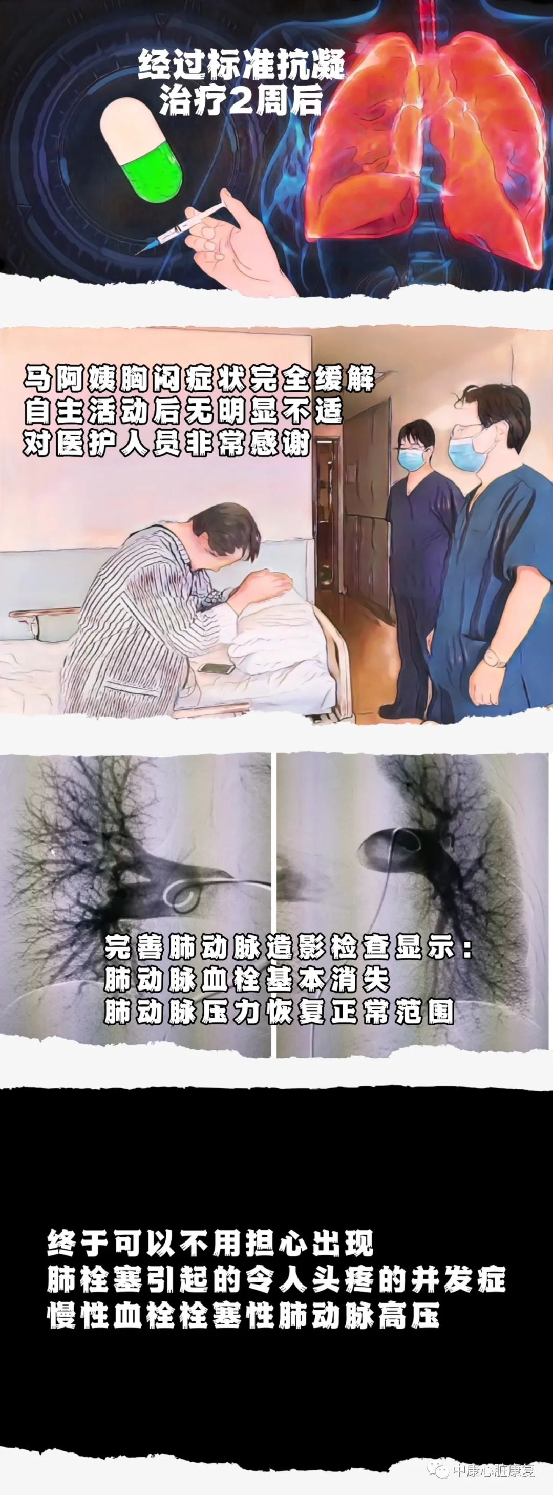 【专家科普】不可忽视的健康杀手—–肺栓塞(一)-图片4