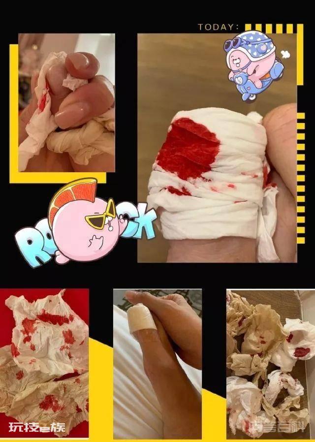 人气女星不慎发生意外踢爆脚趾:希望伤口不要再爆开-图片1