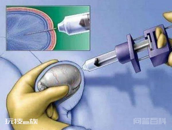 睾丸穿刺取精、显微睾丸取精傻傻分不清？-图片2