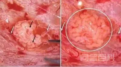 睾丸穿刺取精、显微睾丸取精傻傻分不清？-图片4