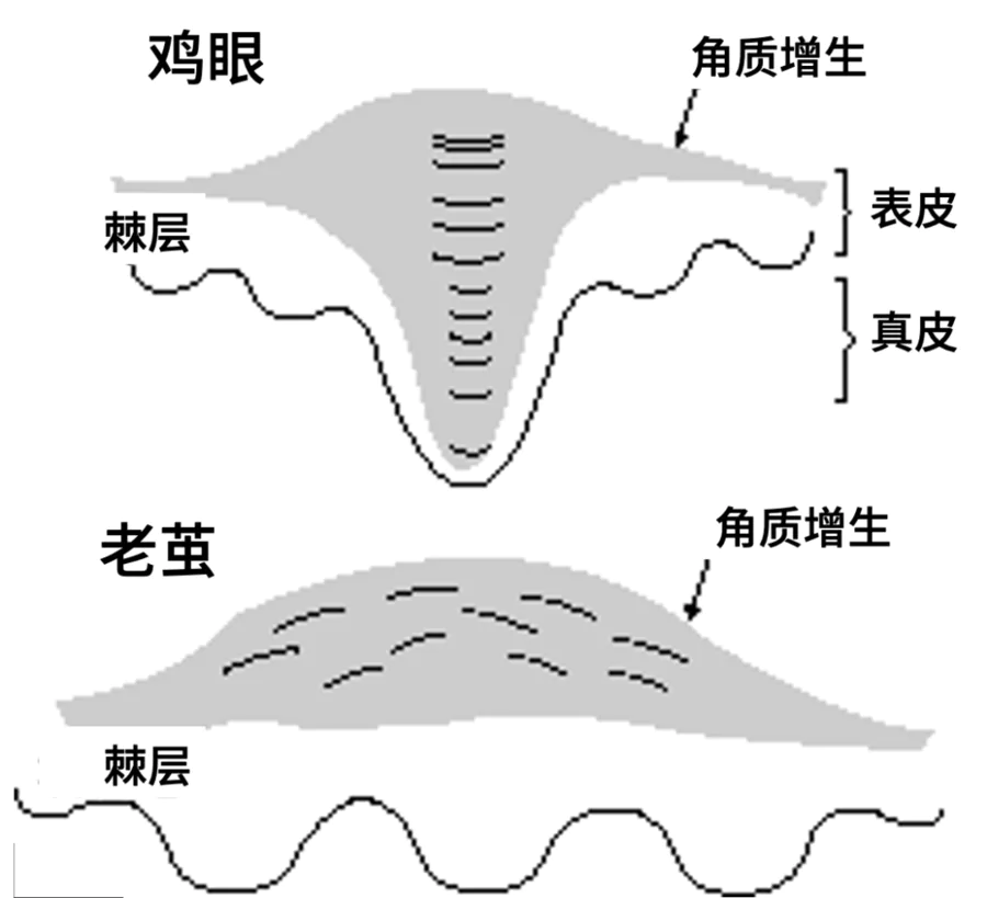 注意!你以为是老茧,其实可能是病毒感染!-图片3