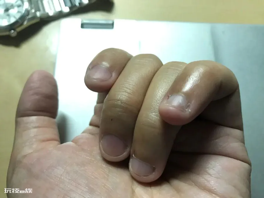 注意!你以为是老茧,其实可能是病毒感染!-图片5
