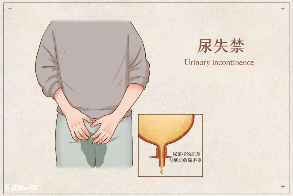 排尿日记怎么记?-图片1