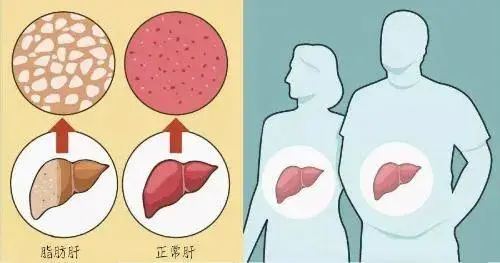 说说脂肪肝的那些事儿