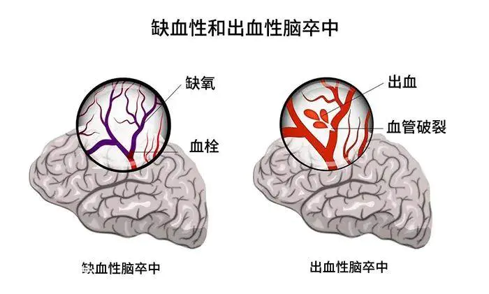 气温骤降 “脑卒中”频发 我们该如何预防?-图片2