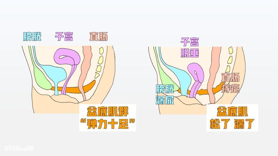 关爱女性健康 从盆底康复做起-图片2