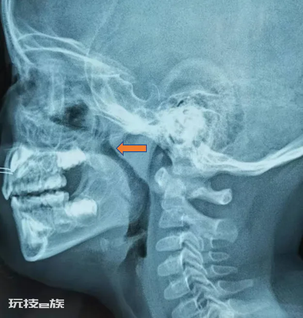 孩子打呼噜怎么办?-图片1