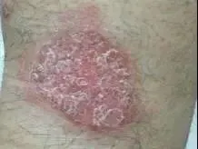 头上起皮、掉壳壳,以为是头皮屑?华西医生喊你当心这种冬季高发皮肤病!-图片3