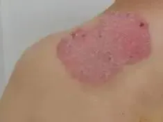 头上起皮、掉壳壳,以为是头皮屑?华西医生喊你当心这种冬季高发皮肤病!-图片4