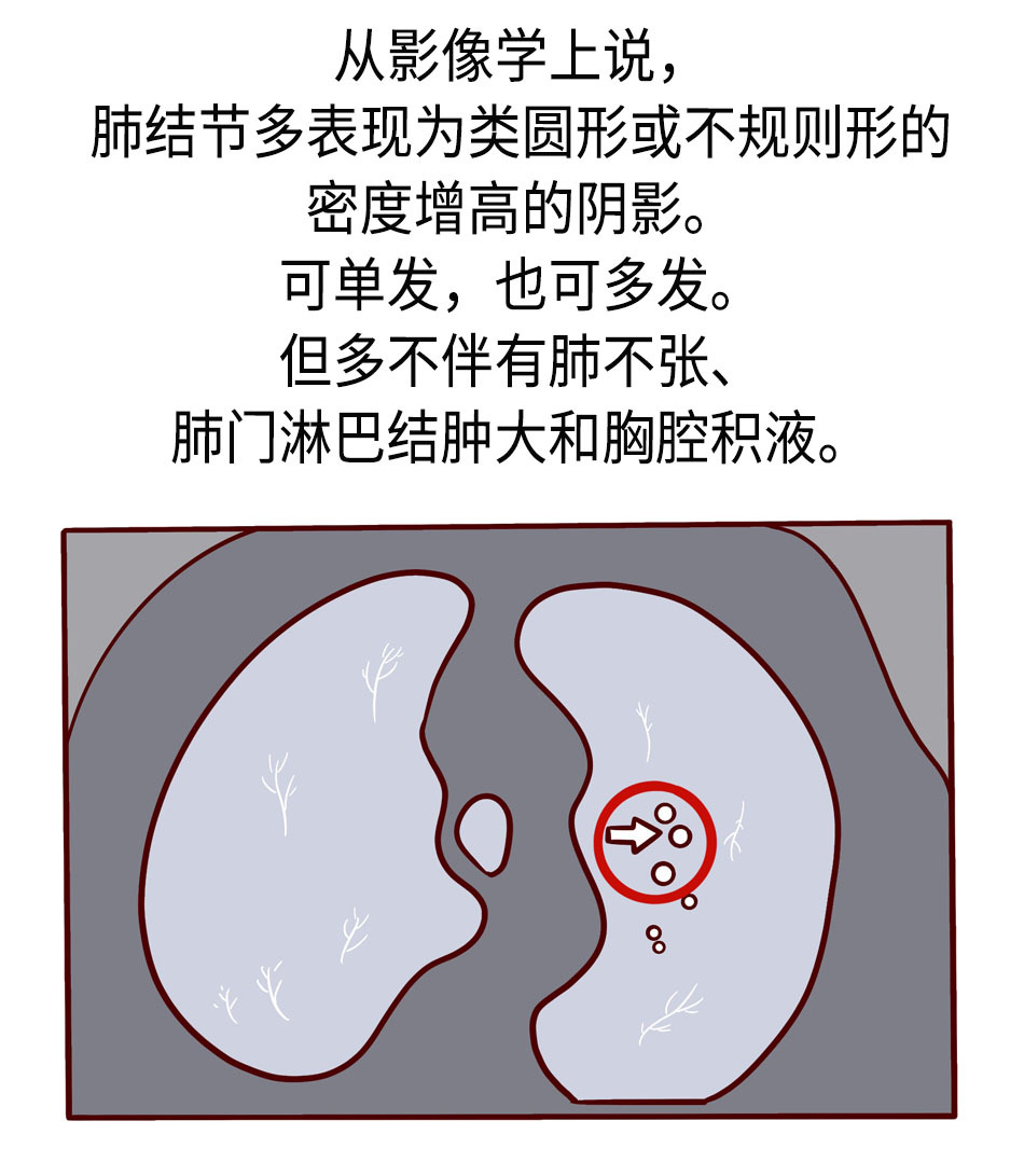 肺结节发展到肺癌，需要经历哪些阶段？
