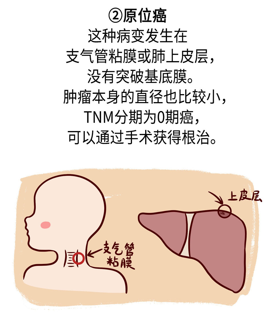 肺结节发展到肺癌，需要经历哪些阶段？